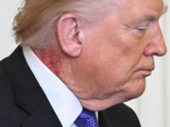 AMERIKA SERIKAT. Bintik Merah di Leher Donald Trump: Apakah Kesehatannya Memburuk?