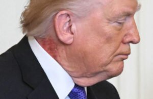 AMERIKA SERIKAT. Bintik Merah di Leher Donald Trump: Apakah Kesehatannya Memburuk?