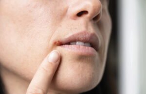 Bagaimana cara mengobati herpes secara alami?